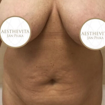 plasmova-liposukce-10-pred (1)