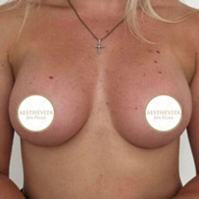 zvetseni-prsou-implantaty-6-po